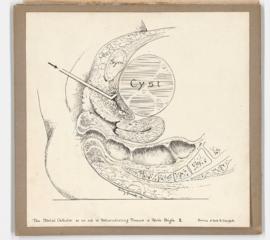 Illustration of metal catheter and pelvic cyst