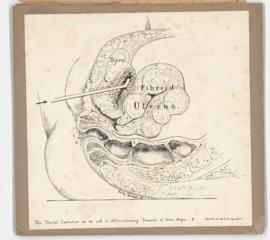 Illustration of metal catheter and uterine fibroids